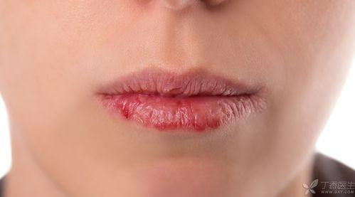 吃瓜嘴角疱疹,揭秘口腔健康危机